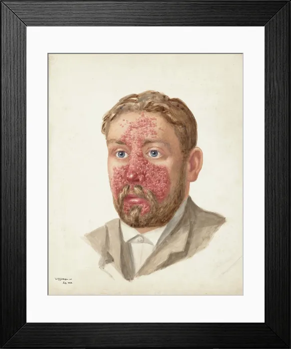 Framed Print : The head of a man with skin disease, July 1889. Creator: W Toogood Hill Framed Print : The head of a man with skin disease, July 1889. Creator: W Toogood Hill