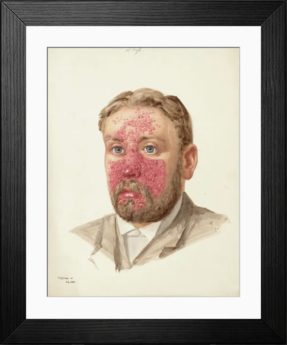 Framed Print : The head of a man with skin disease, July 1889. Creator: W Toogood Hill Framed Print : The head of a man with skin disease, July 1889. Creator: W Toogood Hill