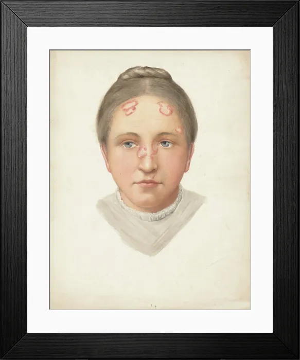 Framed Print : The head of a young woman with loss of skin on her forehead and nose, (1900?). Creator: Jonathan Hutchinson Framed Print : The head of a young woman with loss of skin on her forehead and nose, (1900?). Creator: Jonathan Hutchinson
