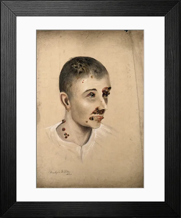 Framed Print : Head of a woman with a severe disease affecting her face and neck, 1864. Creator: Christopher D'Alton. Head of a woman with a severe disease affecting her face and neck, 1864. Creator: Christopher D'Alton Framed Print : Head of a woman with a severe disease affecting her face and neck, 1864. Creator: Christopher D'Alton. Head of a woman with a severe disease affecting her face and neck, 1864. Creator: Christopher D'Alton