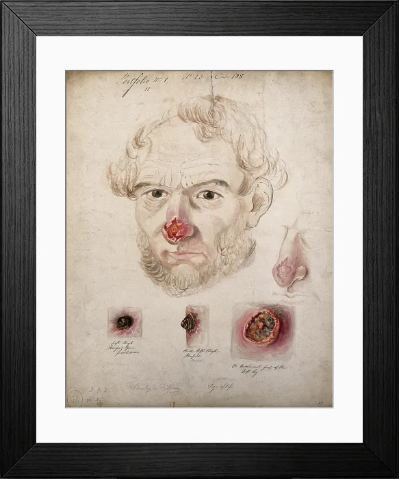 Framed Print : Head of a man with a severe disease affecting his nose; a detail of the nose... 1800-1899. Creator: Christopher D'Alton. Head of a man with a severe disease affecting his nose; a detail of the nose... 1800-1899. Creator: Christopher D'Alton Framed Print : Head of a man with a severe disease affecting his nose; a detail of the nose... 1800-1899. Creator: Christopher D'Alton. Head of a man with a severe disease affecting his nose; a detail of the nose... 1800-1899. Creator: Christopher D'Alton