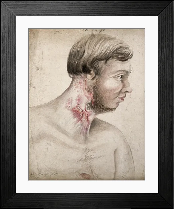 Framed Print : Head and chest of a man with a disease affecting his neck, seen in profile, 1856. Creator: Christopher D'Alton. Head and chest of a man with a disease affecting his neck, seen in profile, 1856. Creator: Christopher D'Alton Framed Print : Head and chest of a man with a disease affecting his neck, seen in profile, 1856. Creator: Christopher D'Alton. Head and chest of a man with a disease affecting his neck, seen in profile, 1856. Creator: Christopher D'Alton