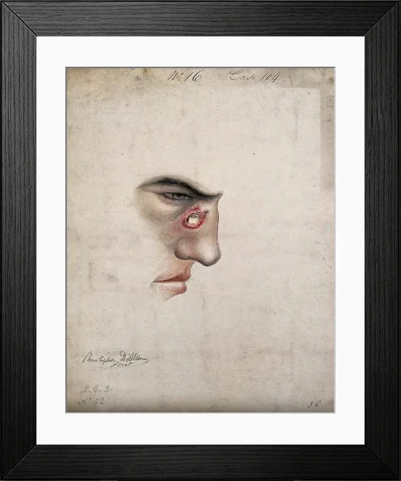 Framed Print : A detail of a man's face seen in profile with a severe disease affecting his nose, 1856. Creator: Christopher D'Alton. A detail of a man's face seen in profile with a severe disease affecting his nose, 1856. Creator: Christopher D'Alton Framed Print : A detail of a man's face seen in profile with a severe disease affecting his nose, 1856. Creator: Christopher D'Alton. A detail of a man's face seen in profile with a severe disease affecting his nose, 1856. Creator: Christopher D'Alton