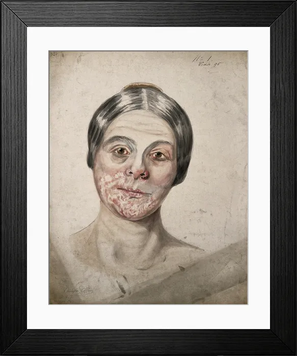 Framed Print : Head of a woman with a severe disease affecting her face, 1800-1899. Creator: Christopher D'Alton. Head of a woman with a severe disease affecting her face, 1800-1899. Creator: Christopher D'Alton Framed Print : Head of a woman with a severe disease affecting her face, 1800-1899. Creator: Christopher D'Alton. Head of a woman with a severe disease affecting her face, 1800-1899. Creator: Christopher D'Alton