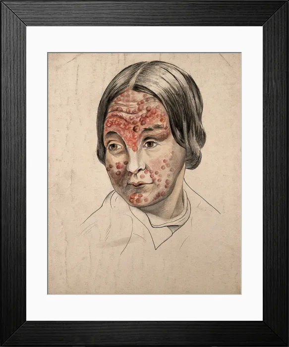 Framed Print : Head of a woman with a severe disease affecting her face, (18)58. Creator: Christopher D'Alton. Head of a woman with a severe disease affecting her face, (18)58. Creator: Christopher D'Alton Framed Print : Head of a woman with a severe disease affecting her face, (18)58. Creator: Christopher D'Alton. Head of a woman with a severe disease affecting her face, (18)58. Creator: Christopher D'Alton