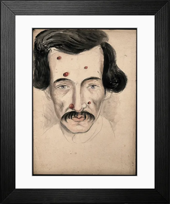 Framed Print : Head of a man with a disease affecting his face, 1800-1899. Creator: Christopher D'Alton. Head of a man with a disease affecting his face, 1800-1899. Creator: Christopher D'Alton Framed Print : Head of a man with a disease affecting his face, 1800-1899. Creator: Christopher D'Alton. Head of a man with a disease affecting his face, 1800-1899. Creator: Christopher D'Alton