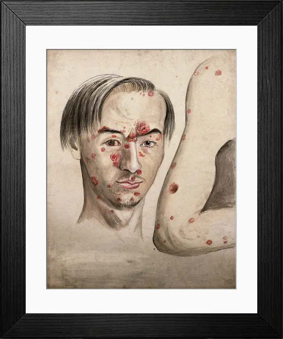 Framed Print : Head of a man with a severe disease affecting his face; and a section of diseased arm, 1800-1899. Creator: Christopher D'Alton. Head of a man with a severe disease affecting his face; and a section of diseased arm, 1800-1899 Framed Print : Head of a man with a severe disease affecting his face; and a section of diseased arm, 1800-1899. Creator: Christopher D'Alton. Head of a man with a severe disease affecting his face; and a section of diseased arm, 1800-1899