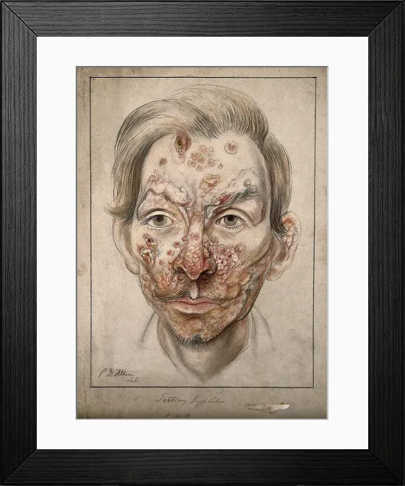 Framed Print : Head of a man with a syphilitic lesions affecting his face, 1874. Creator: Christopher D'Alton. Head of a man with a syphilitic lesions affecting his face, 1874. Creator: Christopher D'Alton Framed Print : Head of a man with a syphilitic lesions affecting his face, 1874. Creator: Christopher D'Alton. Head of a man with a syphilitic lesions affecting his face, 1874. Creator: Christopher D'Alton