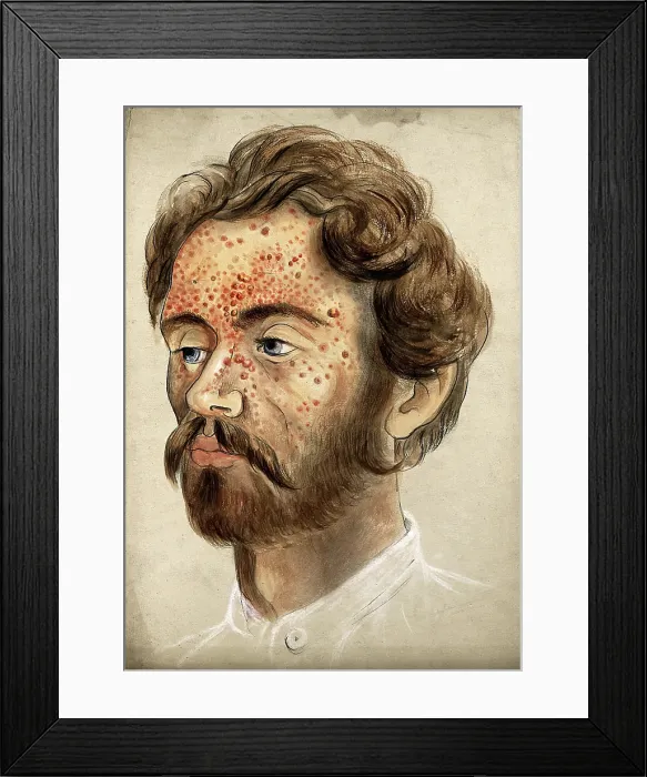 Framed Print : Head of a man with a severe disease affecting his face, (18)60. Creator: Christopher D'Alton. Head of a man with a severe disease affecting his face, (18)60. Creator: Christopher D'Alton Framed Print : Head of a man with a severe disease affecting his face, (18)60. Creator: Christopher D'Alton. Head of a man with a severe disease affecting his face, (18)60. Creator: Christopher D'Alton