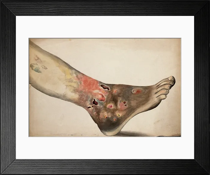 Framed Print : A diseased foot and lower leg. Creator: Unknown Framed Print : A diseased foot and lower leg. Creator: Unknown
