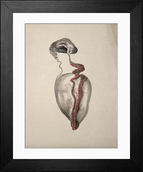 Framed Print : A diseased part of the body. Creator: Unknown Framed Print : A diseased part of the body. Creator: Unknown