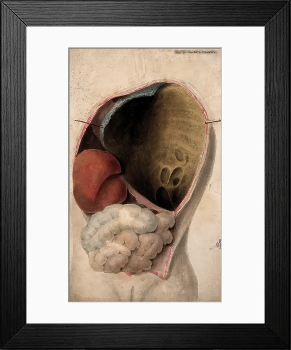 Framed Print : A dissected thorax with a collection of pus in the cavity, c1824. Creator: Unknown Framed Print : A dissected thorax with a collection of pus in the cavity, c1824. Creator: Unknown