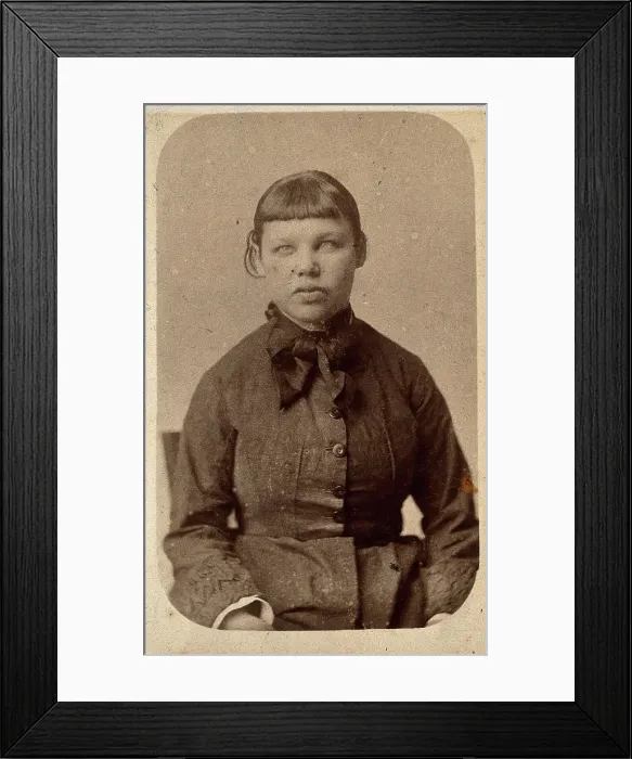 Framed Print : A young woman with a short fringe, showing signs of mental deficiency, c1860s. Creator: John Davis Framed Print : A young woman with a short fringe, showing signs of mental deficiency, c1860s. Creator: John Davis