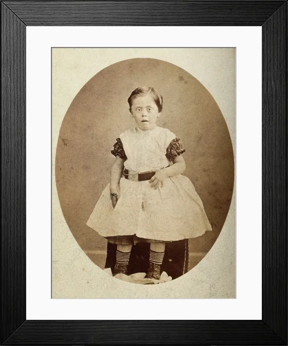 Framed Print : A girl with Down's syndrome, sitting, wearing striped socks, c1890s. Creator: Joseph Arthur Baldry. A girl with Down's syndrome, sitting, wearing striped socks, c1890s Framed Print : A girl with Down's syndrome, sitting, wearing striped socks, c1890s. Creator: Joseph Arthur Baldry. A girl with Down's syndrome, sitting, wearing striped socks, c1890s