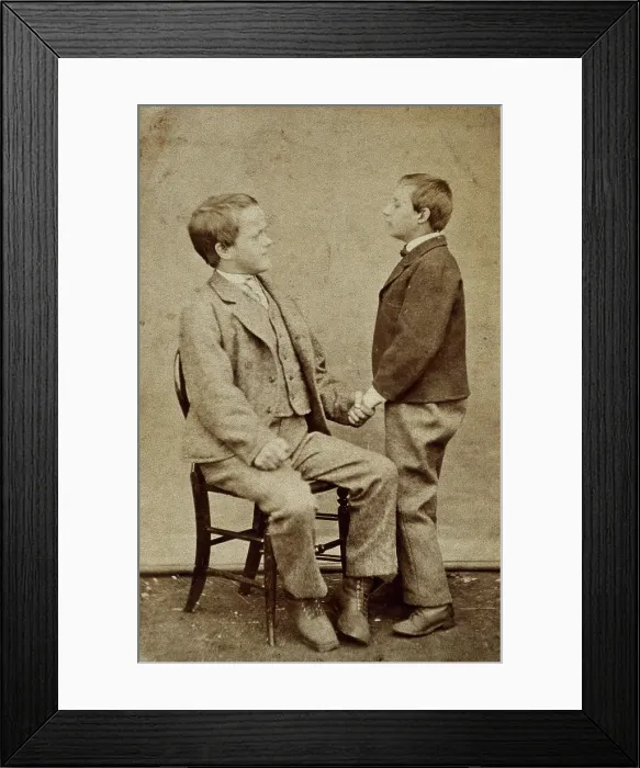 Framed Print : Down's syndrome: in two young men holding hands, one sitting and one standing, c1880s Framed Print : Down's syndrome: in two young men holding hands, one sitting and one standing, c1880s