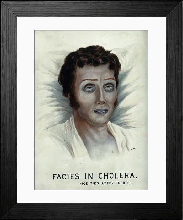 Framed Print : A cholera victim with a typical facial appearance, 1920-1950. Creator: Unknown Framed Print : A cholera victim with a typical facial appearance, 1920-1950. Creator: Unknown