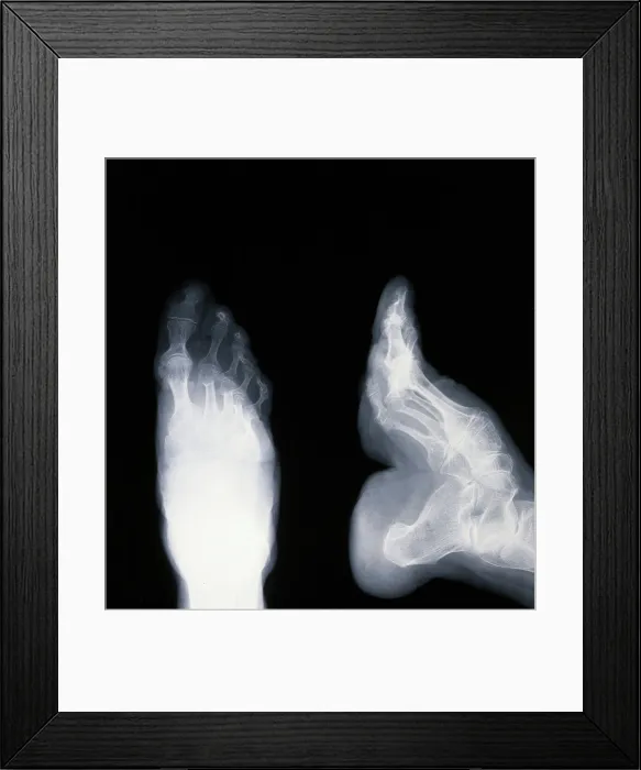 Framed Print : A deformed foot: X-ray, 20th century. Creator: Unknown Framed Print : A deformed foot: X-ray, 20th century. Creator: Unknown