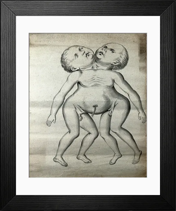 Framed Print : Male conjoined twins joined at the neck and chest; anterior view, 1900. Creator: Unknown Framed Print : Male conjoined twins joined at the neck and chest; anterior view, 1900. Creator: Unknown