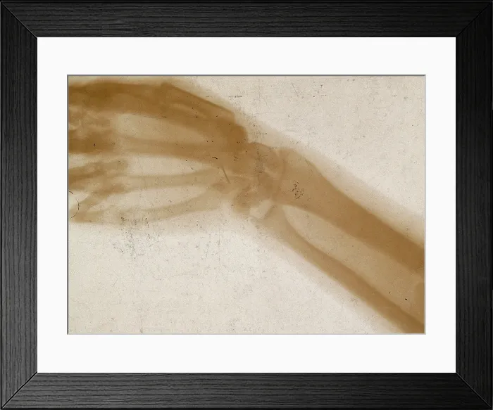 Framed Print : The bones of a hand and wrist, viewed through x-ray, 1896 Framed Print : The bones of a hand and wrist, viewed through x-ray, 1896