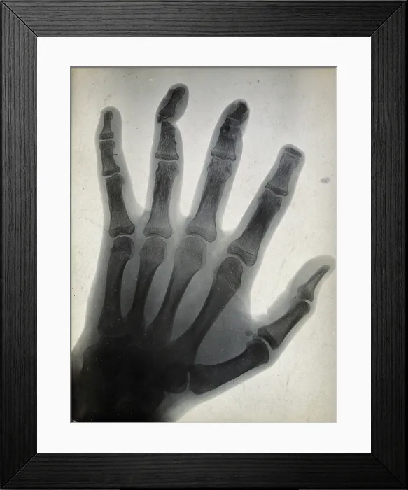 Framed Print : The bones of a hand, with the tip of the index finger missing, viewed through x-ray, 1896 Framed Print : The bones of a hand, with the tip of the index finger missing, viewed through x-ray, 1896