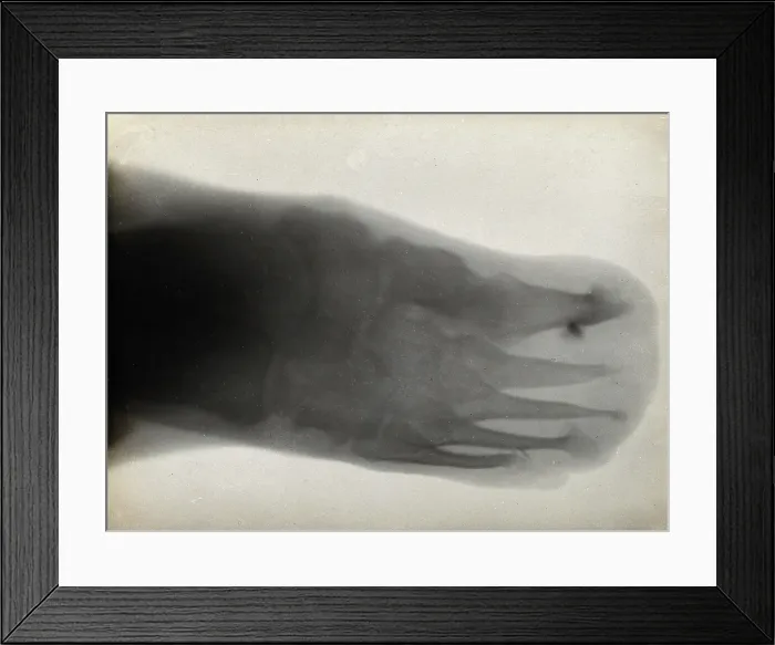 Framed Print : The bones of a foot, possibly with leprosy, viewed through x-ray, 1896 Framed Print : The bones of a foot, possibly with leprosy, viewed through x-ray, 1896