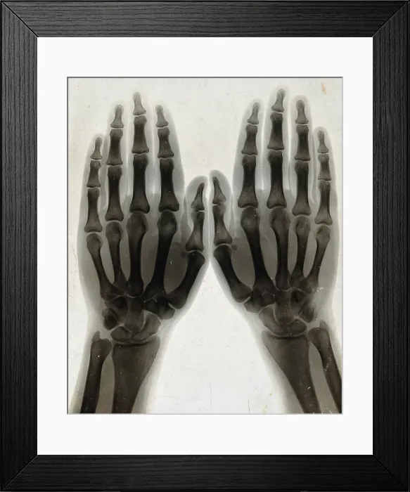 Framed Print : Two hands, viewed through x-ray, 1896 Framed Print : Two hands, viewed through x-ray, 1896