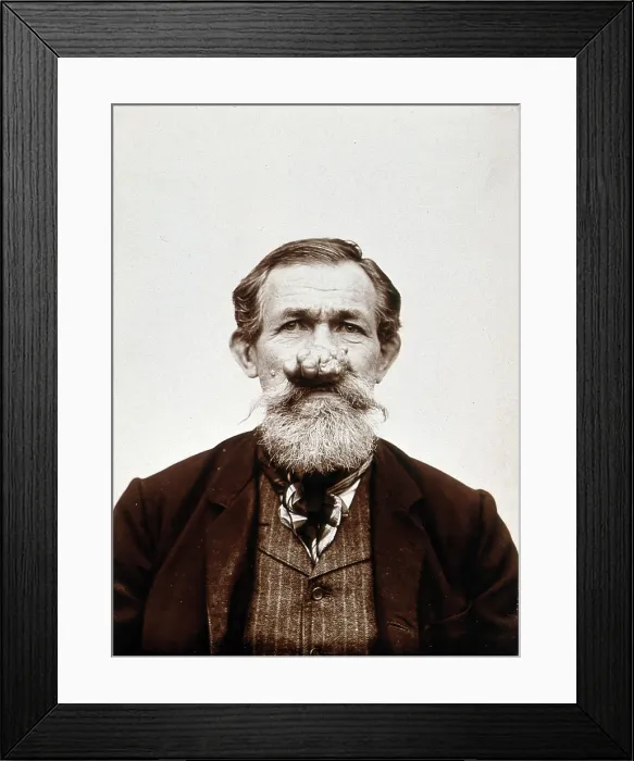 Framed Print : A patient of Leon Desguin, before operation, c1890s. Creator: Unknown Framed Print : A patient of Leon Desguin, before operation, c1890s. Creator: Unknown