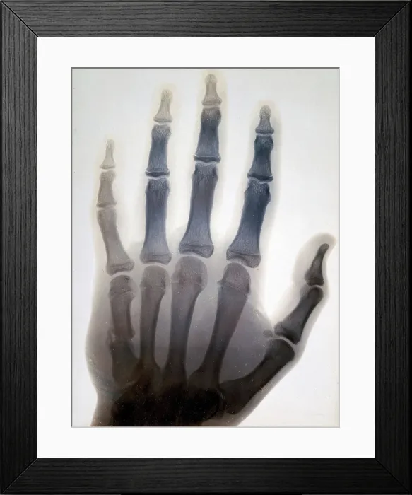 Framed Print : Sir Gervas Powell Glyn, 6th Bart: radiograph of his hand, 1896. Creator: Sir GP Glyn Framed Print : Sir Gervas Powell Glyn, 6th Bart: radiograph of his hand, 1896. Creator: Sir GP Glyn