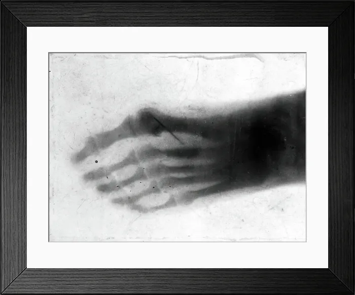 Framed Print : The bones of a pantomime artist's foot, viewed through x-ray; revealing a needle by one of... 1896 Framed Print : The bones of a pantomime artist's foot, viewed through x-ray; revealing a needle by one of... 1896