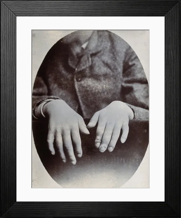 Framed Print : The hands of a child, showing deformity, particularly around the fingertips, c1890s. Creator: N. Goulton May Framed Print : The hands of a child, showing deformity, particularly around the fingertips, c1890s. Creator: N. Goulton May