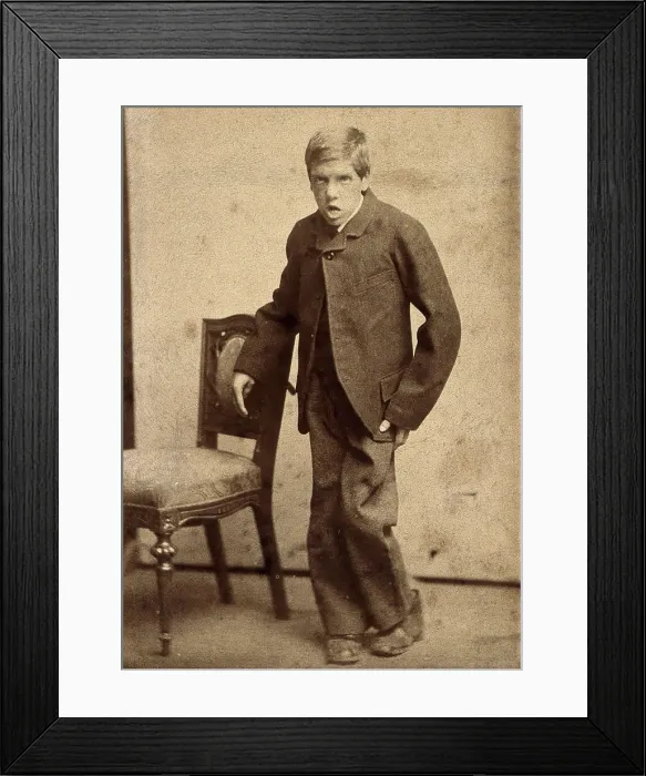 Framed Print : A young man, showing signs of mental deficiency, leaning awkwardly... c1890s. Creator: Davis Framed Print : A young man, showing signs of mental deficiency, leaning awkwardly... c1890s. Creator: Davis
