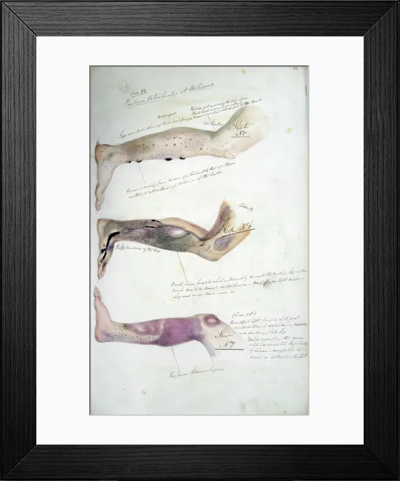 Framed Print : The effects of scurvy, February 1841. Creator: Henry Walsh Mahon Framed Print : The effects of scurvy, February 1841. Creator: Henry Walsh Mahon