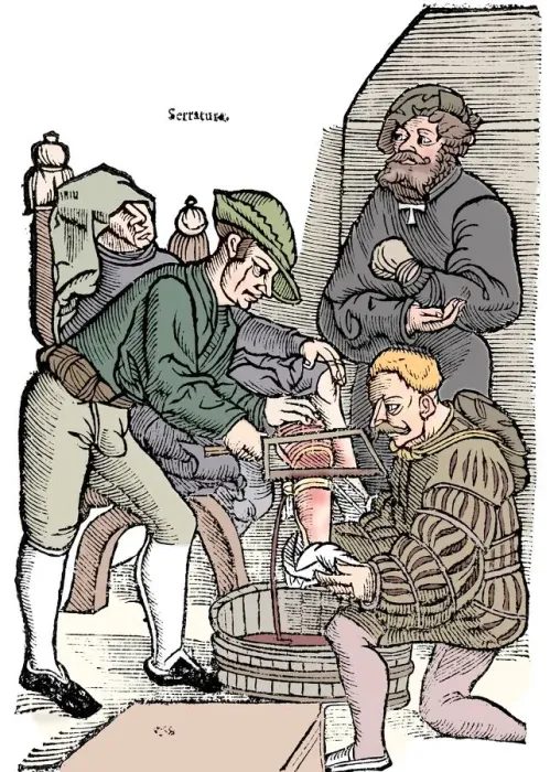 Framed Print : Amputation of a leg without anaesthetic, 1593 Framed Print : Amputation of a leg without anaesthetic, 1593