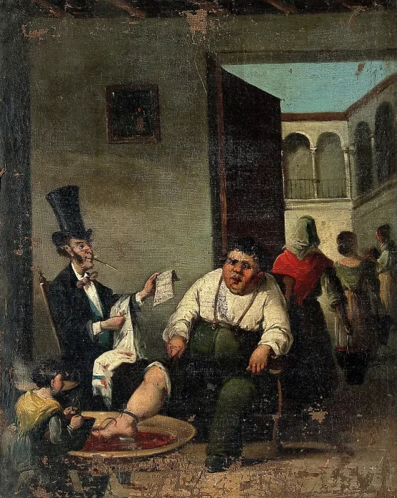 Framed Print : Bloodletting from the foot. Creator: Daumier, Honore, 1808-1879 (After) Framed Print : Bloodletting from the foot. Creator: Daumier, Honore, 1808-1879 (After)