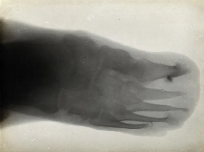 Framed Print : The bones of a foot, possibly with leprosy, viewed through x-ray, 1896 Framed Print : The bones of a foot, possibly with leprosy, viewed through x-ray, 1896