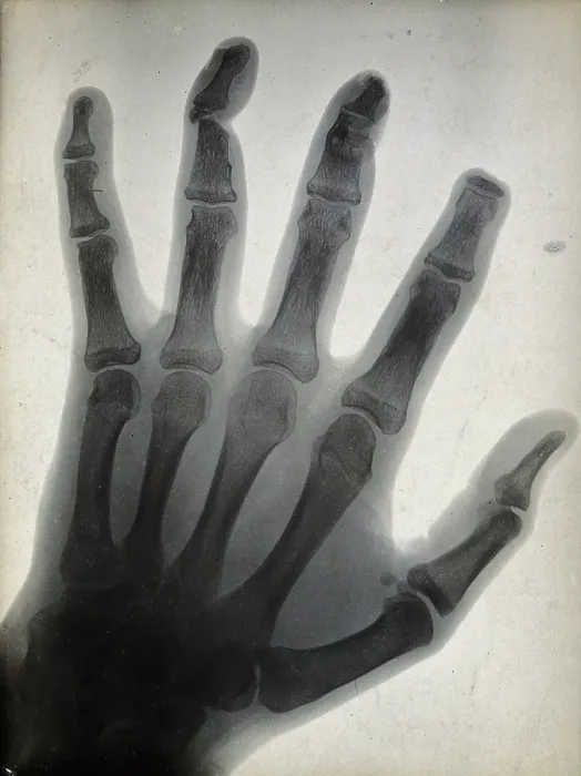 Framed Print : The bones of a hand, with the tip of the index finger missing, viewed through x-ray, 1896 Framed Print : The bones of a hand, with the tip of the index finger missing, viewed through x-ray, 1896
