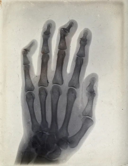 Framed Print : The bones of a hand, viewed through x-ray, 1895 Framed Print : The bones of a hand, viewed through x-ray, 1895