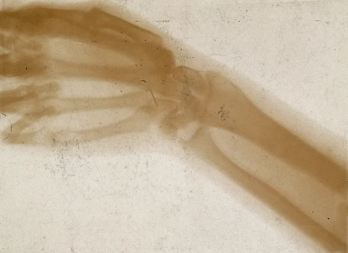 Framed Print : The bones of a hand and wrist, viewed through x-ray, 1896 Framed Print : The bones of a hand and wrist, viewed through x-ray, 1896
