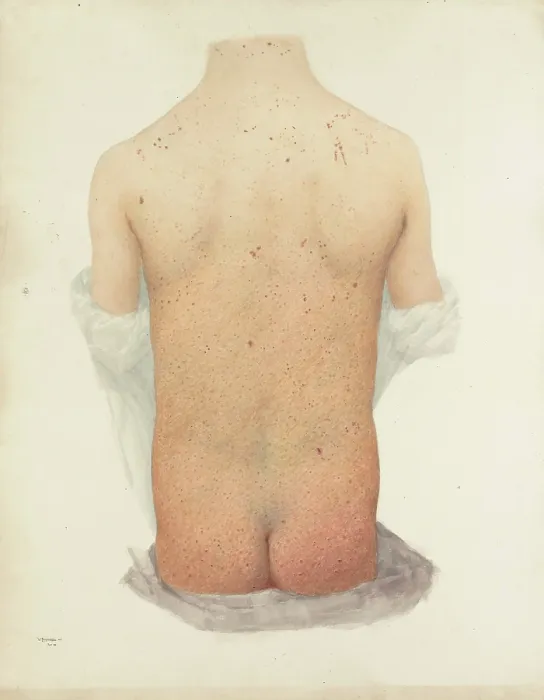 Framed Print : Back of a boy with skin disease, 1891. Creator: W Toogood Hill Framed Print : Back of a boy with skin disease, 1891. Creator: W Toogood Hill