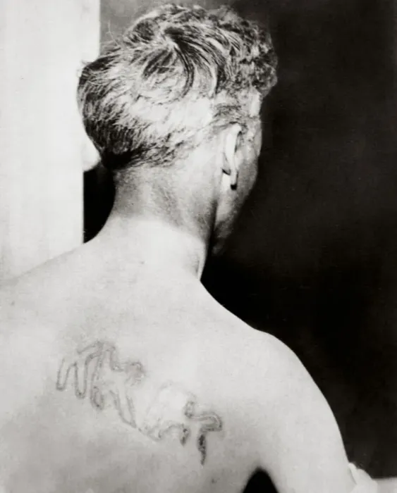 Framed Print : The branded back of Reverend Orrin Van Loon, Detroit, Michigan, USA, July 1924. Artist Framed Print : The branded back of Reverend Orrin Van Loon, Detroit, Michigan, USA, July 1924. Artist