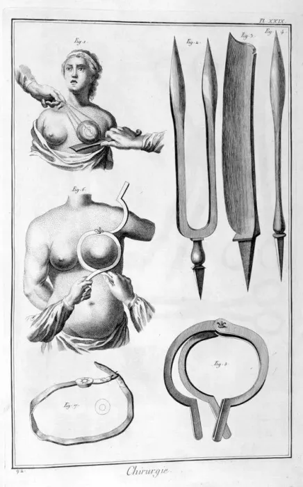 Framed Print : Breast surgery, 1751-1777 Framed Print : Breast surgery, 1751-1777
