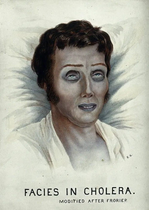 Framed Print : A cholera victim with a typical facial appearance, 1920-1950. Creator: Unknown Framed Print : A cholera victim with a typical facial appearance, 1920-1950. Creator: Unknown