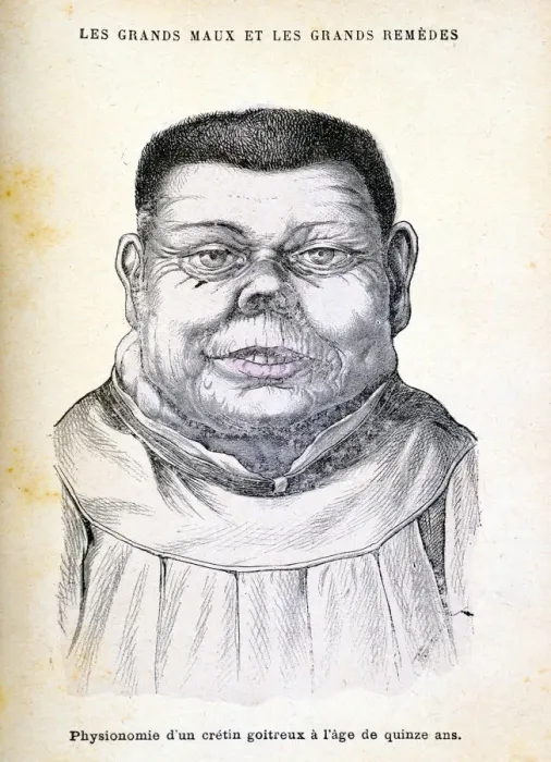 Framed Print : Cretin aged 15, c1890 Framed Print : Cretin aged 15, c1890