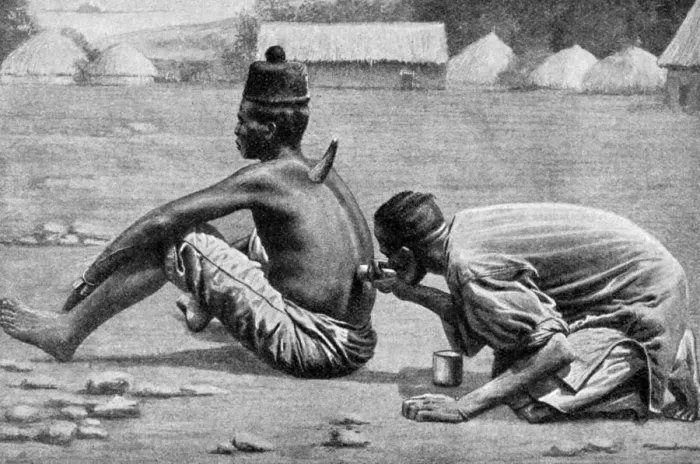 Framed Print : Cupping, wet and dry, as a therapeutic measure, Africa, 1922. Artist: FW Taylor Framed Print : Cupping, wet and dry, as a therapeutic measure, Africa, 1922. Artist: FW Taylor