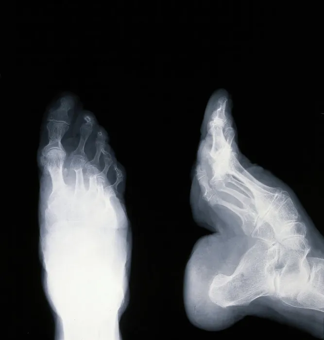 Framed Print : A deformed foot: X-ray, 20th century. Creator: Unknown Framed Print : A deformed foot: X-ray, 20th century. Creator: Unknown