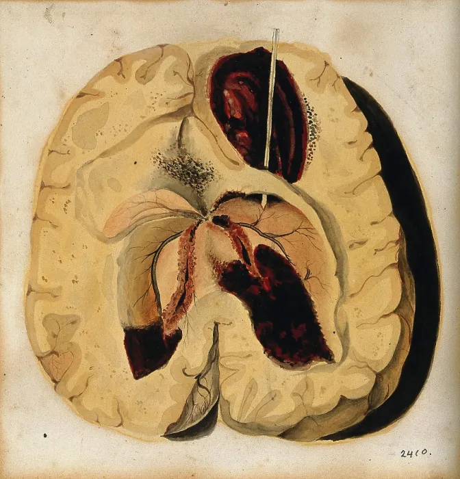 Framed Print : A diseased brain, 1800-1850. Creator: Richard Bright Framed Print : A diseased brain, 1800-1850. Creator: Richard Bright
