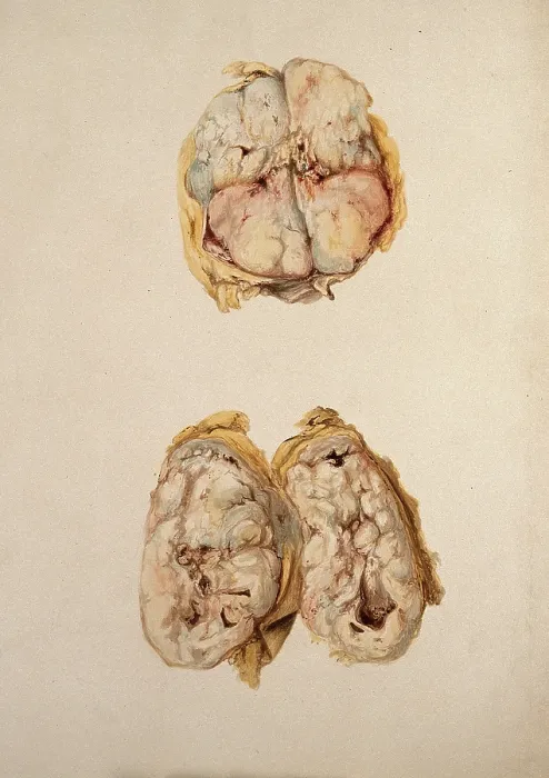 Framed Print : Two diseased parts of the body. Creator: Unknown Framed Print : Two diseased parts of the body. Creator: Unknown