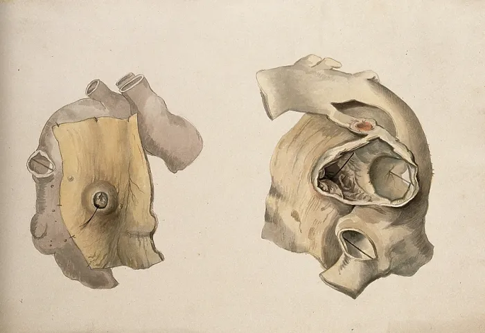 Framed Print : Two diseased parts of the body. Creator: Unknown Framed Print : Two diseased parts of the body. Creator: Unknown