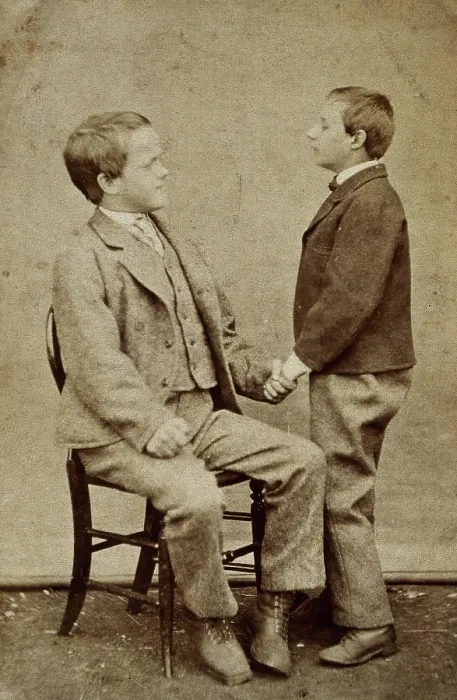 Framed Print : Down's syndrome: in two young men holding hands, one sitting and one standing, c1880s Framed Print : Down's syndrome: in two young men holding hands, one sitting and one standing, c1880s