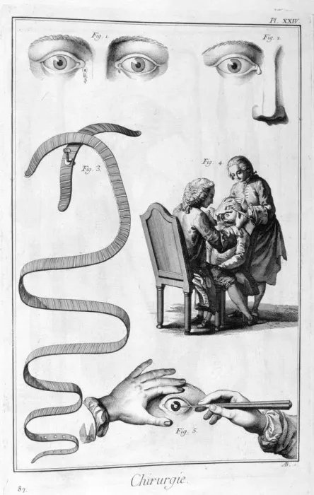 Framed Print : Eye surgery, 1751-1777 Framed Print : Eye surgery, 1751-1777